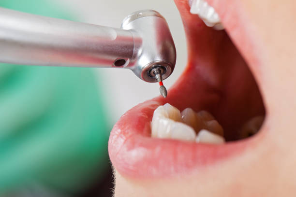 Best Emergency Root Canal Treatment in North Scituate, MA